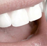 Zahnersatz aus Zirkon - für strahlend weiße Zähne
