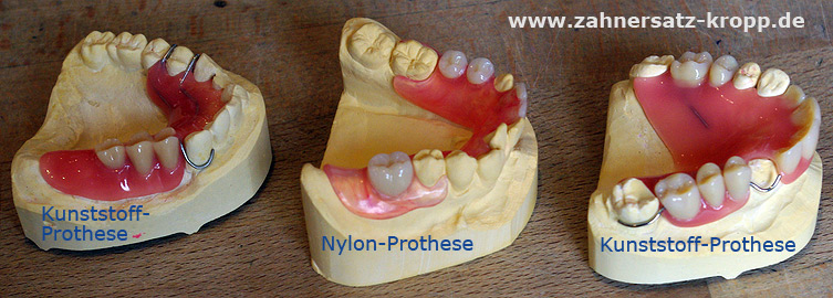 Zahnprothese: Vergleich Kunststoff und Nylon
